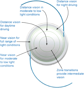 All You Need To Know About Multifocal Implants For Cataracts Neovision Eye Center