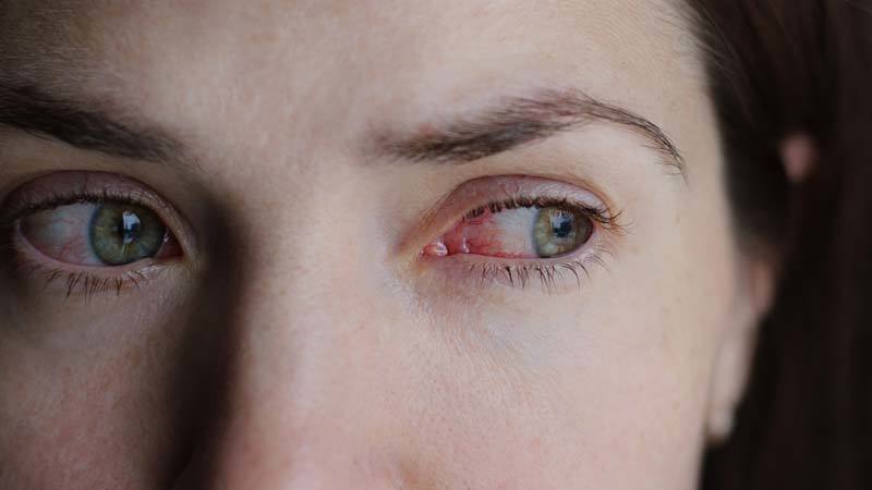 repeated eye infections