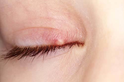 Chalazion — Eye Infections Mountain View Cyst